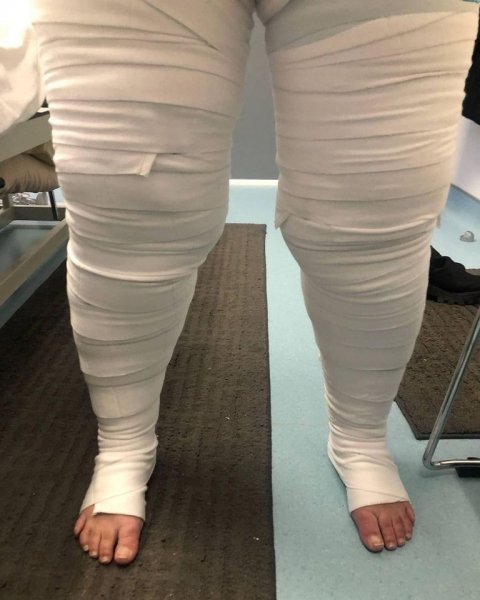 lipedema leg image.jpg lipedema leg image.jpg